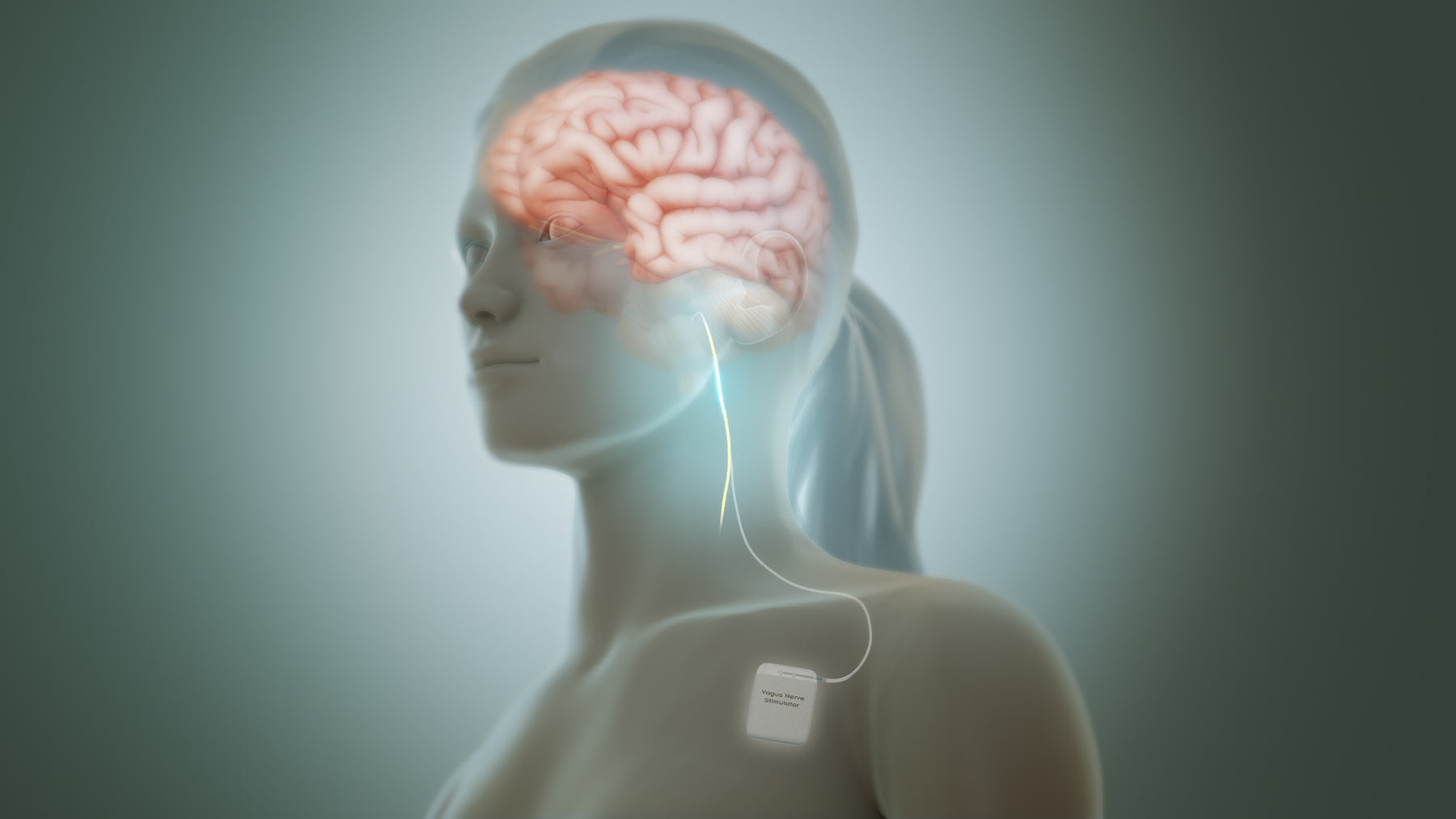 Vagus Nerve Stimulation: A Comprehensive Guide for Managing Depression